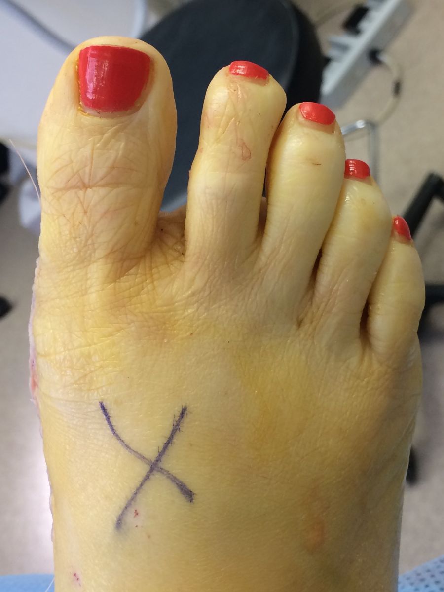 Bunion after